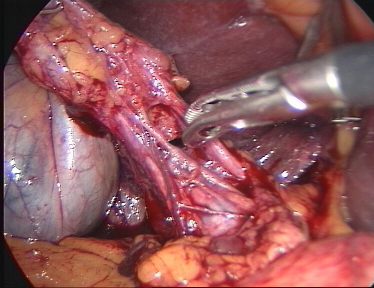 Prparationszonen lap. Cholezystektomie - bei Klick Vergrerung !!